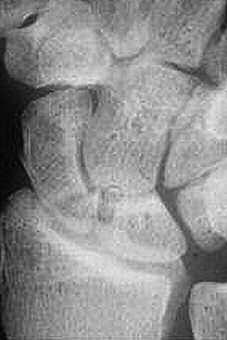 316 A B Figura 2. A) Frattura del polo prossimale; B) Osteosintesi percutanea per via dorsale.