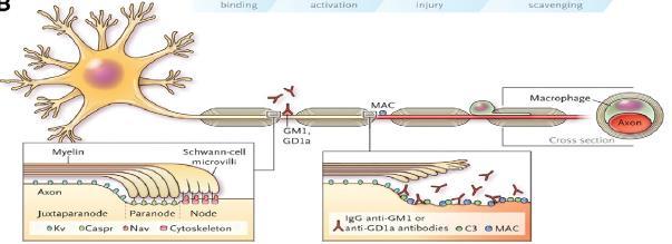 Meccanismi patogenetici nella neuropatia motoria acuta assonale (AMAN) Gli anticorpi anti anti-gd1a o anti-gm1 si legano all assolemma nodale: