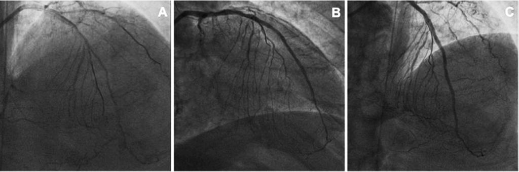 19_19 02/02/16 08.12 Pagina 208 Fig. 5. Caso di malattia diffusa con piccolo lume uniforme, sottoposto ad impianto di stent riassorbibili.