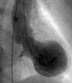 alterazioni acute del microcircolo, si riscontra quasi