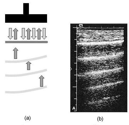 Fig. 9.7 Effetti di riverberazione dei fasci ultrasonori nei tessuti.