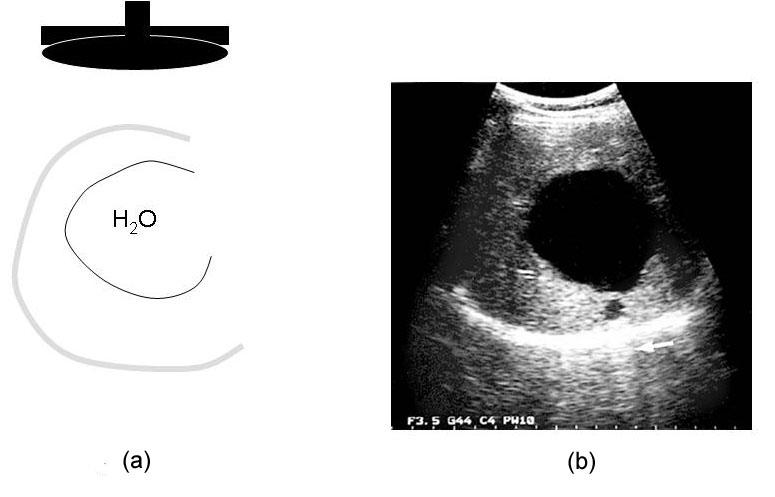alla sonda in tempi successivi e vengono interpretati dall ecografo come provenienti da altre superfici più profonde (b) Fig.