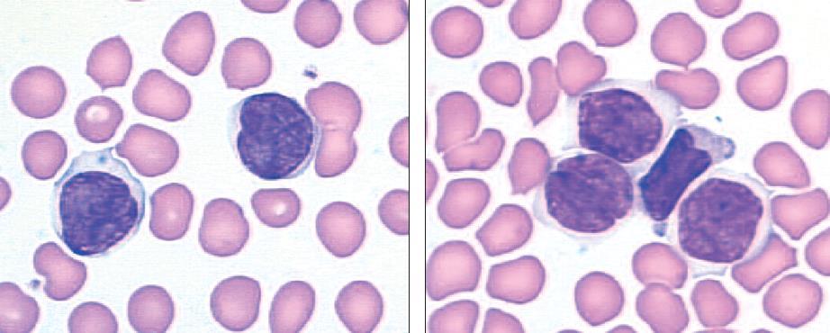 Leucemia-linfoma cutaneo a