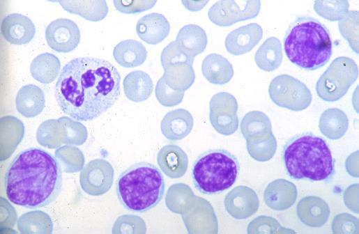 Leucemia-linfoma cutaneo a