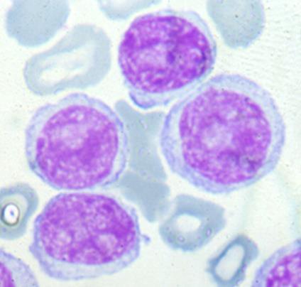 La cellula indicata è: un linfocita, verosimilmente normale un linfocita atipico, probabilmente