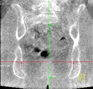 CBCT CT