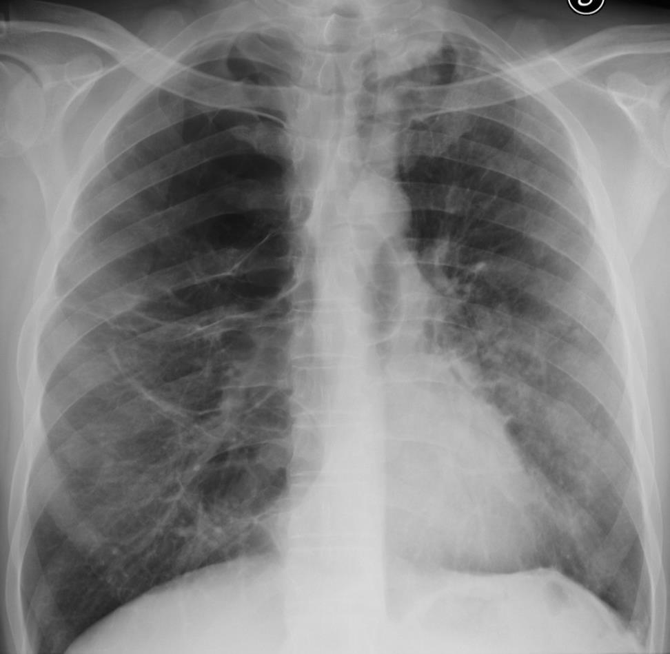 BPCO a common preventable and treatable disease characterized by persistent airflow