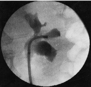 URETEROLITOTRISSIA INDICAZIONI