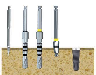 CORE Procedure chirurgiche 1 2 3 4 CORE Ø 2.9 Legenda: 1 fresa iniziale 2 fresa super cut Ø 2 mm 3 fresa super cut Ø 2,5 mm 4 svasatore Ø 2,9 mm 5 inserimento impianto 5 N.B.: CORE Ø 3.