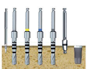 1 2 3 4 5 CORE Ø 5.0 Legenda: 1 fresa iniziale 2 fresa super cut Ø 2 mm 3 fresa super cut Ø 3 mm 4 fresa super cut Ø 3,85 mm 5 svasatore Ø 5 mm 6 inserimento impianto 6 N.B.: CORE Ø 5.