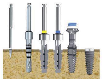 IMPIANTI E INDICAZIONI PROCEDURE CHIRURGICHE 1 2 3 K-CORE Ø 4.