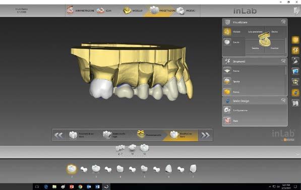 ABSTRACT I partecipanti al corso apprenderanno tecniche per la realizzazione di denti artificiali la cui anatomia si avvicini il più possibile a quella dei denti naturali, realizzati anche grazie