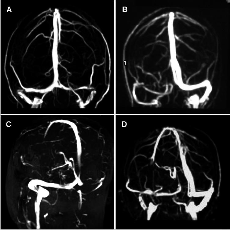 Venous Sinus Stenosis Pazienti con sviluppo di cefalea cronica dopo la normalizzazione dei valori di ICP Coesistenza di emicrania e cefalea muscolo tensiva Donne di età