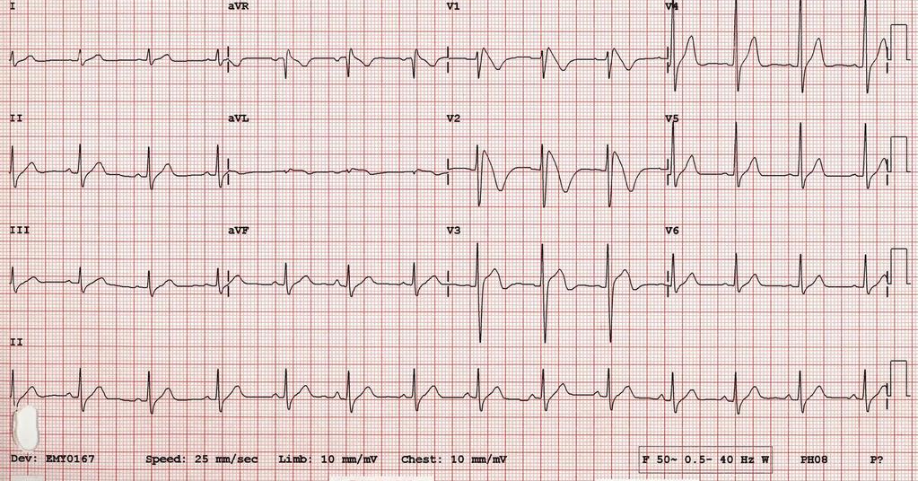 La Sindrome di Brugada-ECG Solo pattern ECG tipo