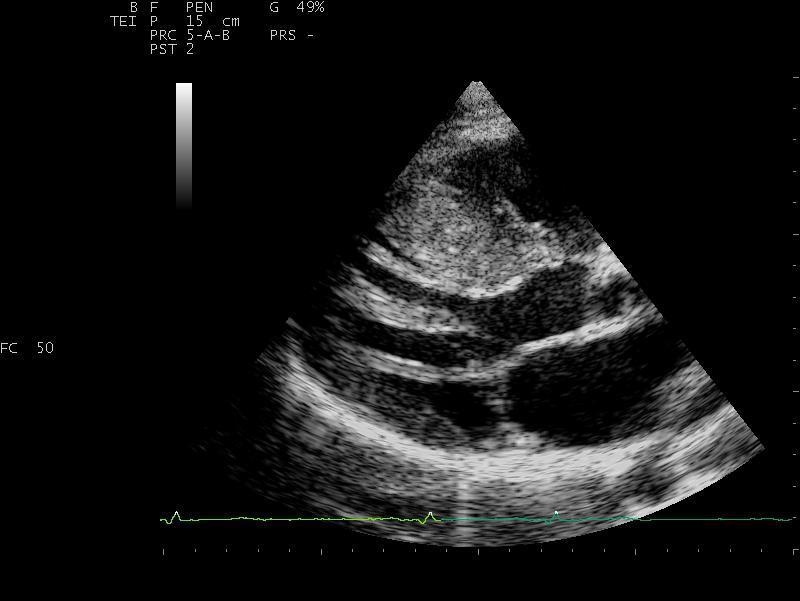 CMI: una miriade di anomalie da valutare Spessori di parete Tralci fibromuscolari TEVS Muscoli papillari anomali