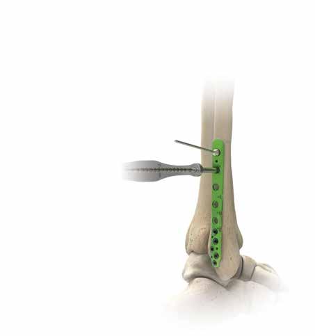 Tecnica chirurgica con placca posterolaterale per perone [segue] Figura 17 5 Posizionamento delle viti esalobate prossimali da 3,5 mm Tutti i fori prossimali della placca sono compatibili con viti