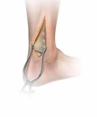 Tecnica chirurgica con placca posterolaterale per tibia distale Figura 25 Nota: il sistema base per frammenti di piccole dimensioni Acumed alloggia le viti e la strumentazione standard necessaria per