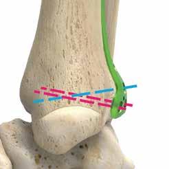 Tecnica chirurgica con placca posterolaterale per tibia distale [segue] 4 Posizionamento delle viti esalobate distali da 2,7 mm Le traiettorie dei fori per viti distali sono angolate circa a 15 gradi