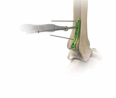 Tecnica chirurgica con placca posterolaterale per tibia distale [segue] 5 Posizionamento delle viti esalobate prossimali da 3,5 mm Tutti i fori prossimali della placca sono compatibili con viti