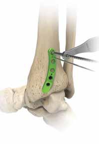 Tecnica chirurgica con placca posteromediale per tibia distale [segue] 5 Posizionamento delle viti esalobate prossimali da 3,5 mm Tutti i fori prossimali della placca sono compatibili con viti