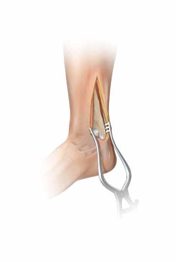 Tecnica chirurgica con placca antiscivolamento mediale Figura 42 Nota: il sistema base per frammenti di piccole dimensioni Acumed alloggia le viti e la strumentazione standard necessaria per questa