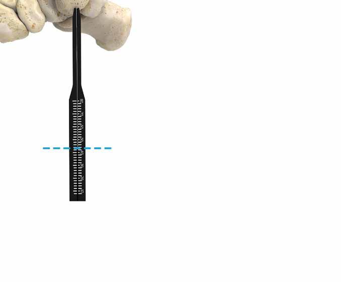 Determinare la lunghezza della vite Figura 69 Inserire il filo guida non filettato da 1,3 mm di modo che sia perpendicolare alla linea di frattura e occupi la futura posizione della vite a testa