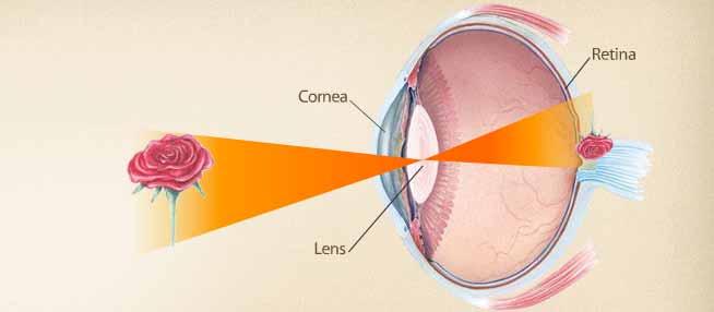 L occhio Nell ipermetropia questo è dovuto alla forma troppo accorciata del bulbo oculare, mentre nella presbiopia (che insorge tipicamente dopo i 40 anni) ad una