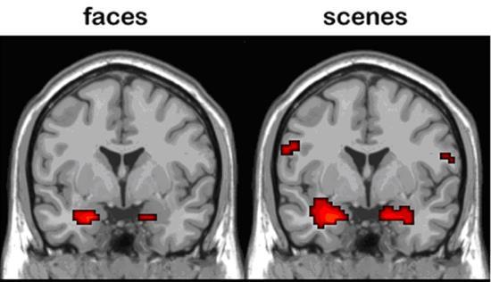 BENZODIAZEPINE ED ANSIA: MECCANISMI Dal punto di vista neuroanatomico, l amigdala, la corteccia orbitofrontale e l insula sono associate alla