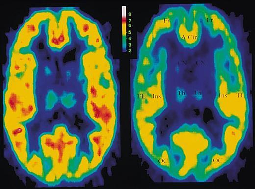 STUDI DI BRAIN IMAGING (2/2) I pazienti con disturbi da attacchi di panico mostrano bassi livelli di