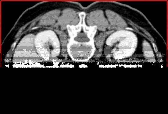 mediastinica.