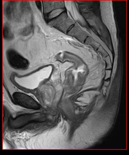 partire da circa 2 cm cranialmente all orifizio