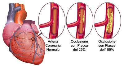 Infarto