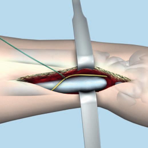 Praticare un incisione cutanea longitudinale sopra l ulna palpabile.