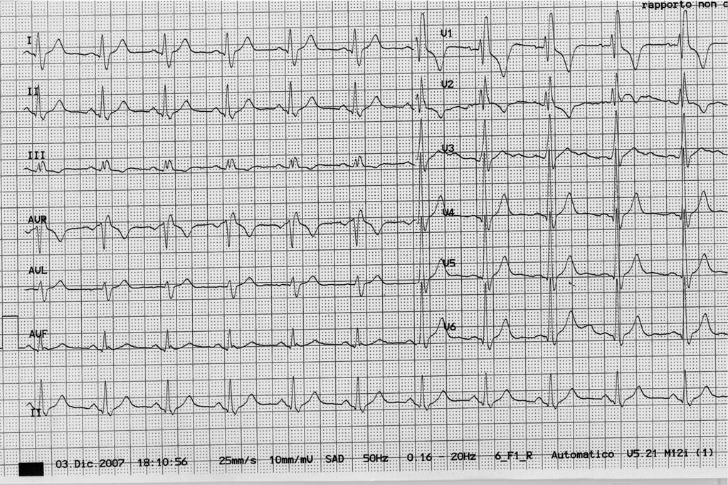 EZIOLOGIA DEI DISTURBI DI CONDUZIONE NEL GIOVANE-ADULTO Un disturbo di conduzione intraventricolare nel giovane-adulto atleta o sedentario può essere innanzitutto legato a una cardiopatia organica