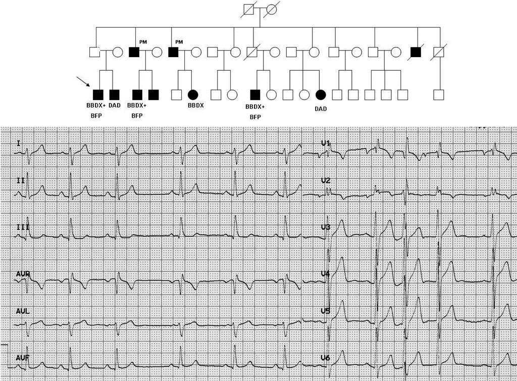 Emiblocco anteriore o posteriore sinistro, blocco di branca destra associato ad emiblocco anteriore o posteriore sinistro La diagnosi di EAS si è basata essenzialmente su una deviazione assiale >-30