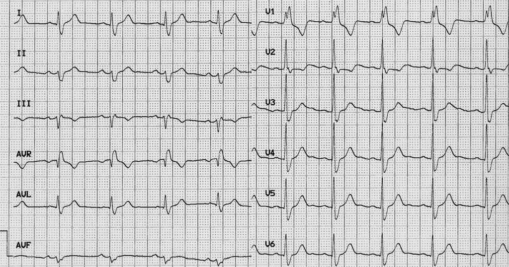 P DELISE ET AL Figura 4. Maschio di 41 anni, praticante sport subacquei. L ECG era normale all età di 23 anni.