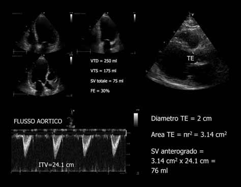 Analogamente, fra i pazienti con SC e insufficienza mitralica significativa, la valutazione dello SV anterogrado permette di stabilire se la PC è ridotta.