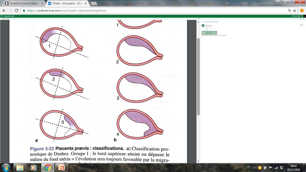 PLACENTA PREVIA FOLLOW UP ECOGRAFICO NON TUTTE le placente basse diagnosticate a 20 sett rimangono previe FENOMENO DI MIGRAZIONE PLACENTARE STUDIO su 714 donne, Dash et all 2002 A 20 sett: placenta