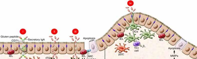 GALT E MALATTIA CELIACA ESPANSIONE DI CLONI DI