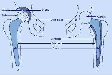 viene sostituita solo la componente femorale, inserendo sullo stelo una testa di maggiori dimensioni (paragonabili a quelle della testa femorale naturale) che si articola direttamente con l'acetabolo