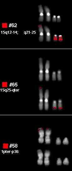 46,XY,der(1)t(1;15) (1pter,15q23)mat Prelievo di