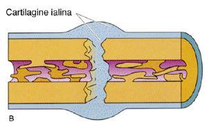 Callo fibrocartilagineo