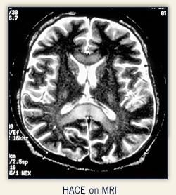 15 Diagnosi HACE dopo un