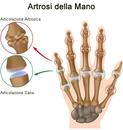 Illustrazione 3: artrosi della mano Tra le malattie osteoarticolari di origine metabolica o reumatismi metabolici la più