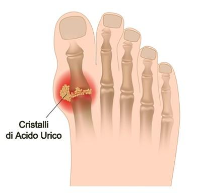 Illustrazione 4: artrite gottosa Le malattie osteoarticolari o reumatismi cosiddetti extraarticolari comprendono forme