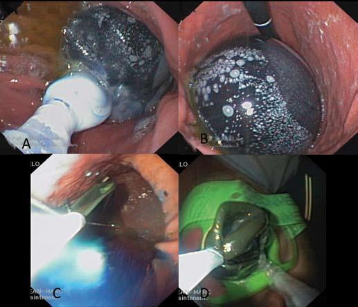 fig. 1: posizionamento (A-B) e rimozione (C-D) di un palloncino intragastrico in un paziente con indice di massa corporea di 34.