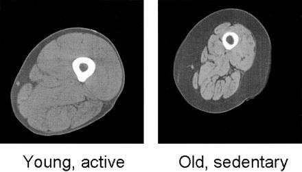 Sarcopenia Massa muscolare più ridotta del previsto in un soggetto di età, sesso,e razza specificati.