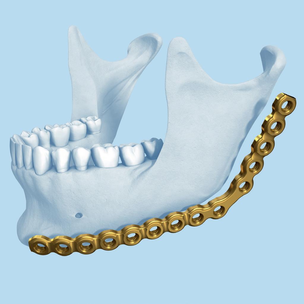 Tecnica chirurgica 3 Scelta e taglio e/o modellamento della placca di ricostruzione Selezionare la placca di ricostruzione adatta al tipo di resezione programmata e all altezza del ramo misurata.