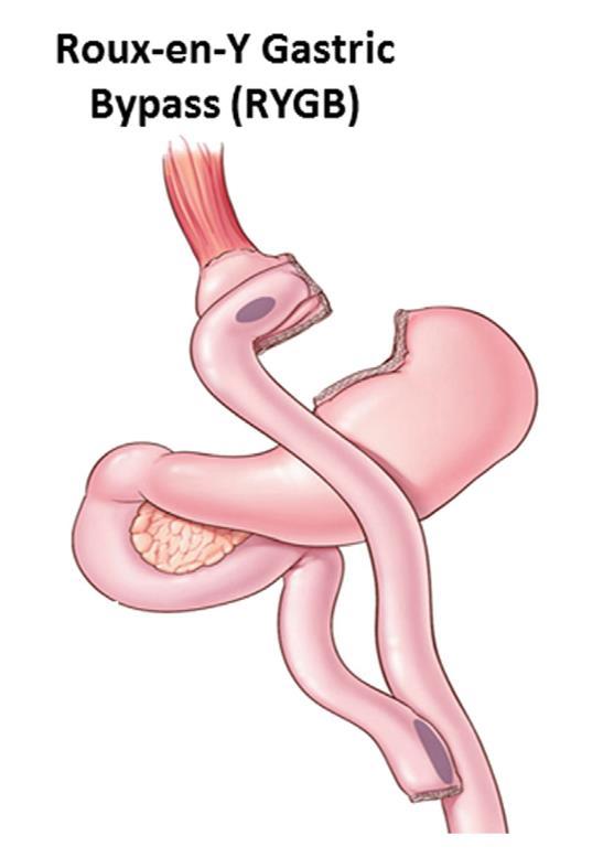 Microbiota e Chirurgia Bariatrica Sleeve Gastrectomy