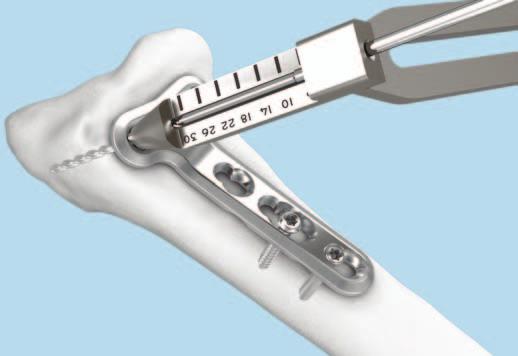 Se necessario, forare con un angolazione diversa e verificare con il braccio snodato (C-arm). Usare il misuratore di profondità per viti da 2.0 mm e 2.